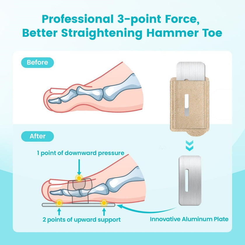Hallux Valgus Overlapping Support Splint Strap Fixing